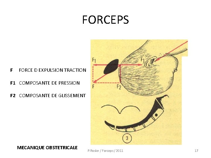 FORCEPS F FORCE D EXPULSION TRACTION F 1 COMPOSANTE DE PRESSION F 2 COMPOSANTE