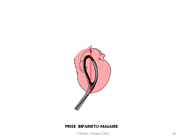  PRISE BIPARIETO-MALAIRE P. Rosier / Forceps / 2011 34 