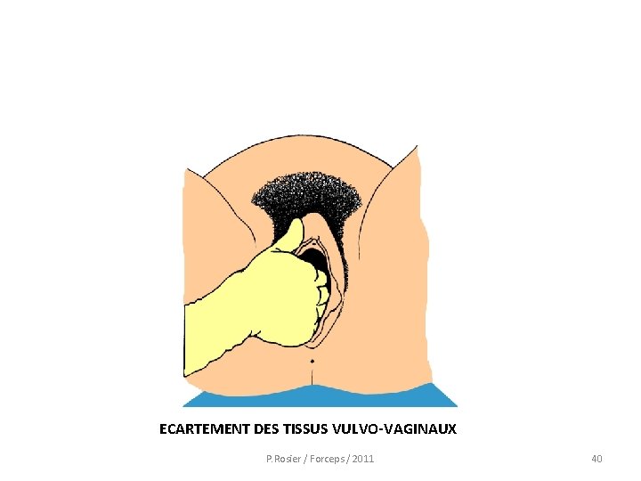  ECARTEMENT DES TISSUS VULVO-VAGINAUX P. Rosier / Forceps / 2011 40 