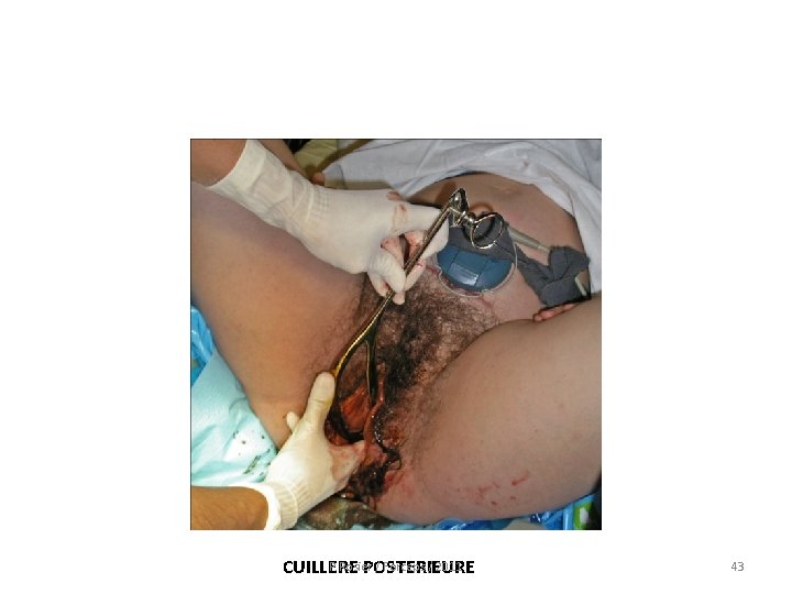 P. Rosier / Forceps / 2011 CUILLERE POSTERIEURE 43 