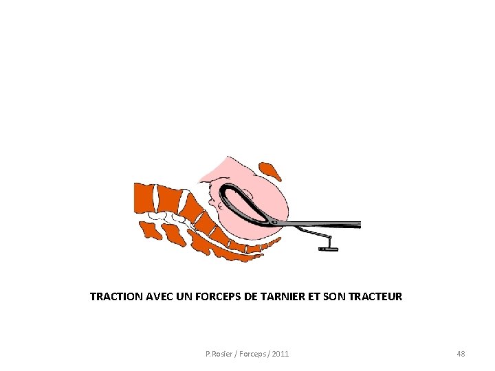 TRACTION AVEC UN FORCEPS DE TARNIER ET SON TRACTEUR P. Rosier / Forceps /