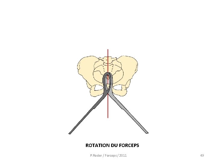 ROTATION DU FORCEPS P. Rosier / Forceps / 2011 49 