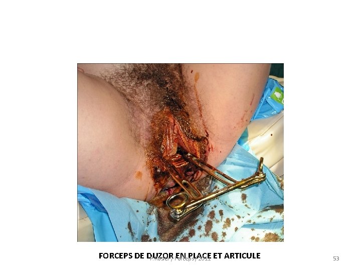  FORCEPS DE DUZOR EN PLACE ET ARTICULE P. Rosier / Forceps / 2011