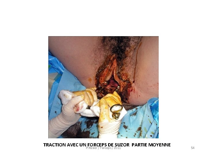  TRACTION AVEC UN FORCEPS DE SUZOR PARTIE MOYENNE P. Rosier / Forceps /