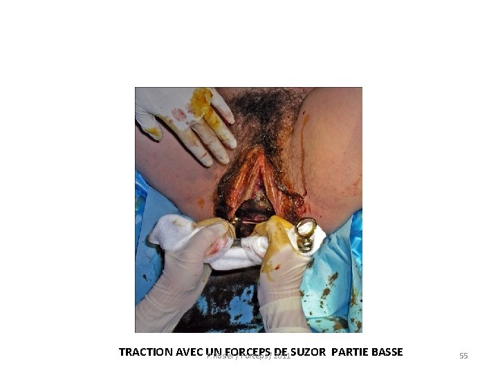  TRACTION AVEC UN FORCEPS DE SUZOR PARTIE BASSE P. Rosier / Forceps /