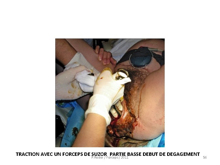  TRACTION AVEC UN FORCEPS DE SUZOR PARTIE BASSE DEBUT DE DEGAGEMENT P. Rosier