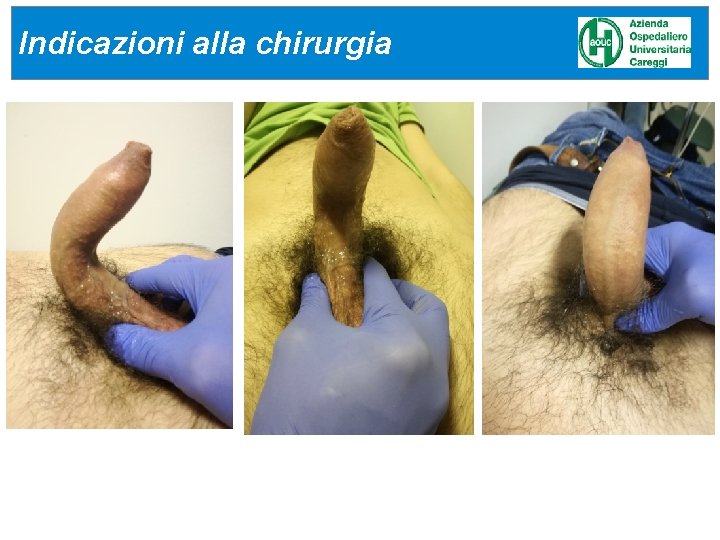 Indicazioni alla chirurgia Indicazioni alla chirurgia