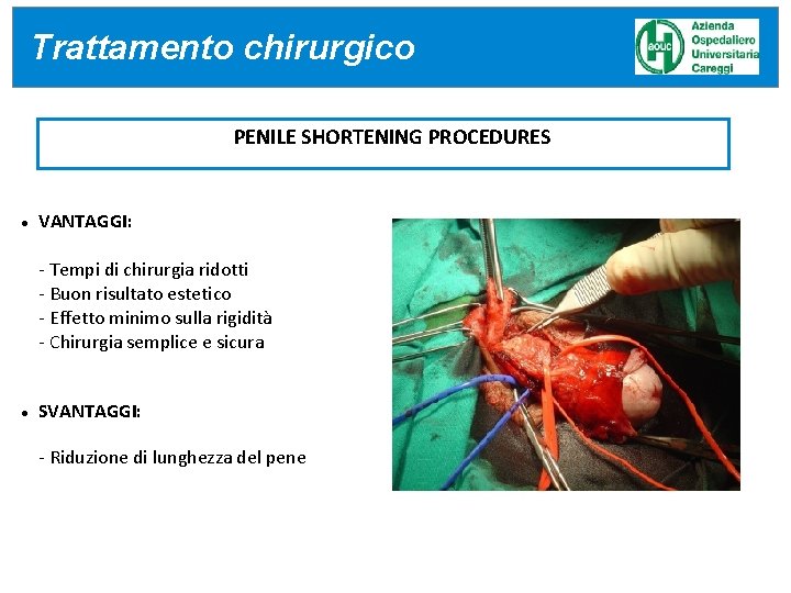 Trattamento CARATTERISTICHE chirurgico PREOPERATORIE PENILE SHORTENING PROCEDURES VANTAGGI: - Tempi di chirurgia ridotti - Trattamento CARATTERISTICHE chirurgico PREOPERATORIE PENILE SHORTENING PROCEDURES VANTAGGI: - Tempi di chirurgia ridotti -