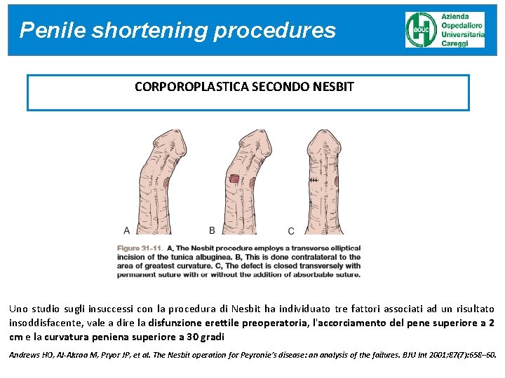 Penile MATERIALE shortening UTILIZZATO procedures CORPOROPLASTICA SECONDO NESBIT Uno studio sugli insuccessi con la Penile MATERIALE shortening UTILIZZATO procedures CORPOROPLASTICA SECONDO NESBIT Uno studio sugli insuccessi con la