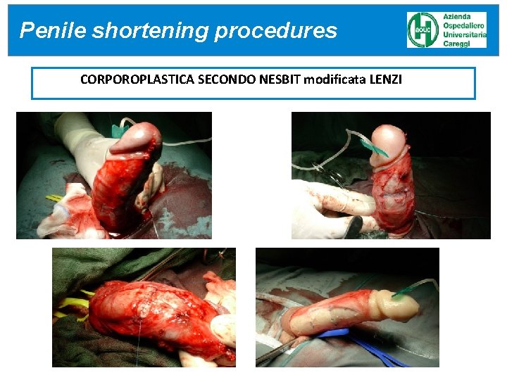 Penile shortening procedures CORPOROPLASTICA SECONDO NESBIT modificata LENZI Penile shortening procedures CORPOROPLASTICA SECONDO NESBIT modificata LENZI