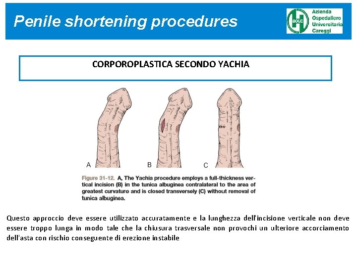 Penile shortening procedures CORPOROPLASTICA SECONDO YACHIA Questo approccio deve essere utilizzato accuratamente e la Penile shortening procedures CORPOROPLASTICA SECONDO YACHIA Questo approccio deve essere utilizzato accuratamente e la
