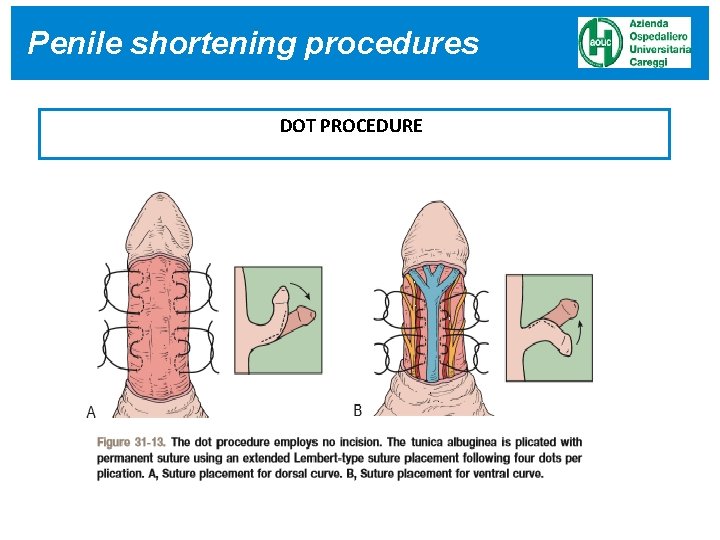 Penile RISULTATI shortening procedures DOT PROCEDURE Penile RISULTATI shortening procedures DOT PROCEDURE