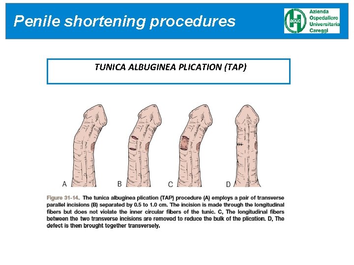 Penile shortening procedures TUNICA ALBUGINEA PLICATION (TAP) Penile shortening procedures TUNICA ALBUGINEA PLICATION (TAP)