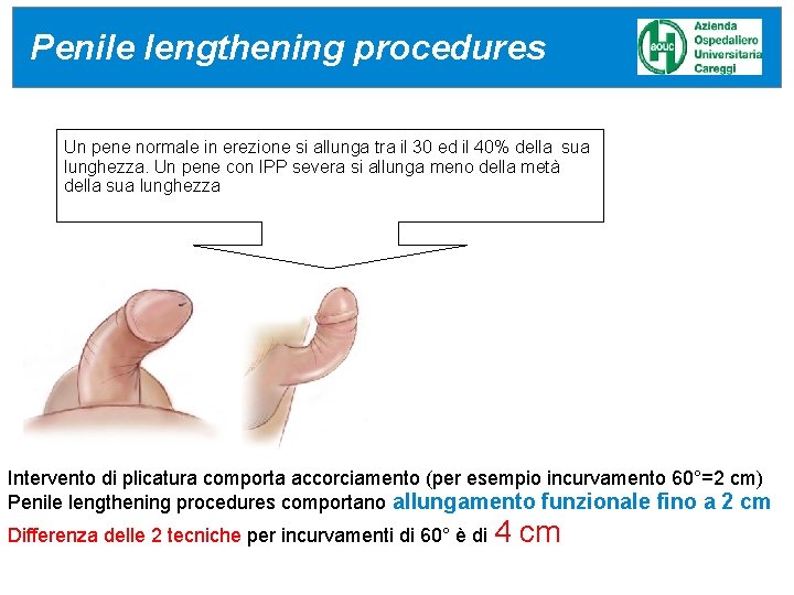 Penile lengthening procedures Un pene normale in erezione si allunga tra il 30 ed Penile lengthening procedures Un pene normale in erezione si allunga tra il 30 ed