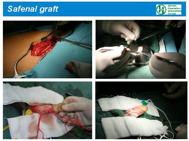 Safenal graft 24/04/17 Safenal graft 24/04/17