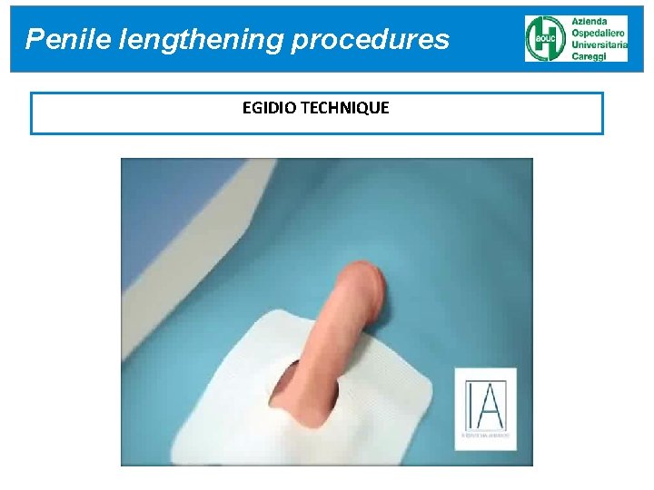 Penile lengthening procedures EGIDIO TECHNIQUE 24/04/17 Penile lengthening procedures EGIDIO TECHNIQUE 24/04/17