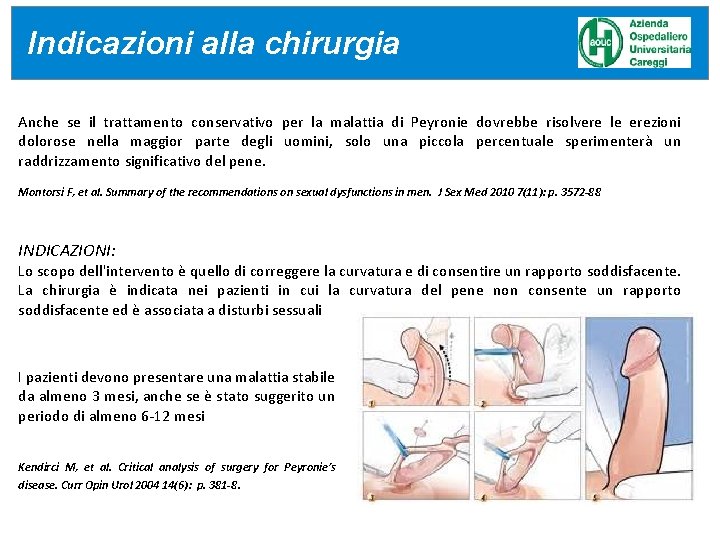 IDEA Indicazioni alla chirurgia Anche se il trattamento conservativo per la malattia di Peyronie IDEA Indicazioni alla chirurgia Anche se il trattamento conservativo per la malattia di Peyronie