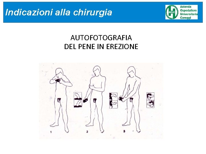 Indicazioni alla chirurgia AUTOFOTOGRAFIA DEL PENE IN EREZIONE Indicazioni alla chirurgia AUTOFOTOGRAFIA DEL PENE IN EREZIONE