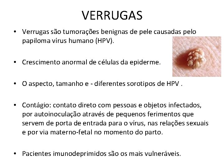 VERRUGAS • Verrugas são tumorações benignas de pele causadas pelo papiloma vírus humano (HPV).