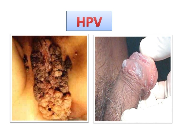 HPV 