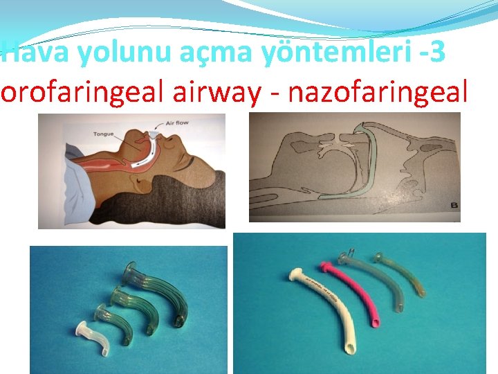 Hava yolunu açma yöntemleri -3 orofaringeal airway - nazofaringeal 
