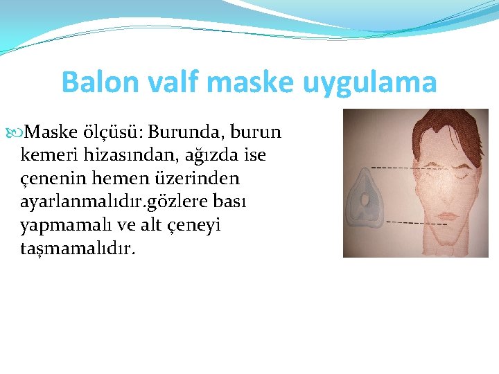 Balon valf maske uygulama Maske ölçüsü: Burunda, burun kemeri hizasından, ağızda ise çenenin hemen