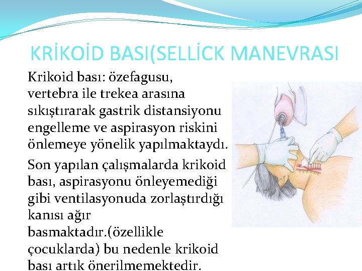 KRİKOİD BASI(SELLİCK MANEVRASI Krikoid bası: özefagusu, vertebra ile trekea arasına sıkıştırarak gastrik distansiyonu engelleme