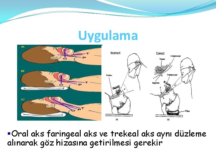 Uygulama §Oral aks faringeal aks ve trekeal aks aynı düzleme alınarak göz hizasına getirilmesi