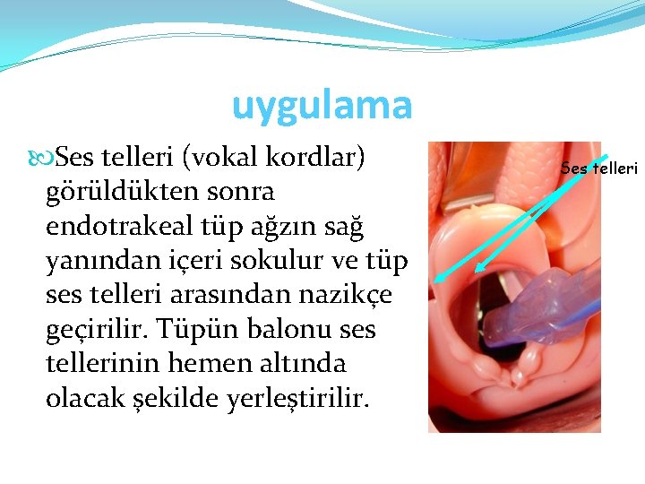 uygulama Ses telleri (vokal kordlar) görüldükten sonra endotrakeal tüp ağzın sağ yanından içeri sokulur