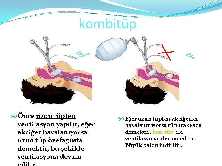 kombitüp Önce uzun tüpten ventilasyon yapılır, eğer akciğer havalanıyorsa uzun tüp özefagusta demektir, bu