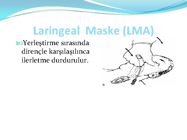 Laringeal Maske (LMA) Yerleştirme sırasında dirençle karşılaşılınca ilerletme durdurulur. 