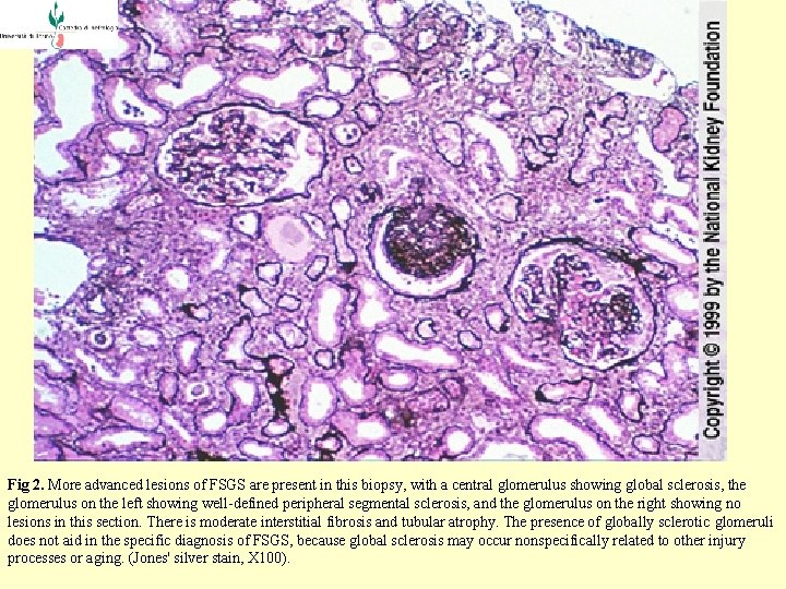  Fig 2. More advanced lesions of FSGS are present in this biopsy, with