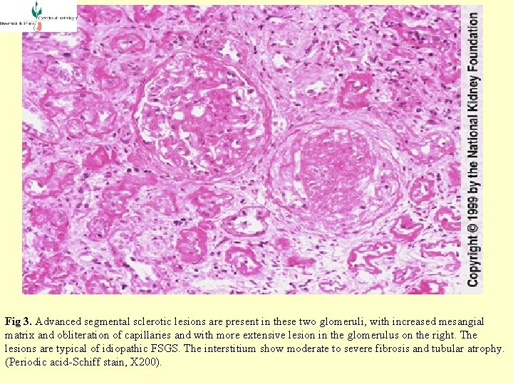  Fig 3. Advanced segmental sclerotic lesions are present in these two glomeruli, with