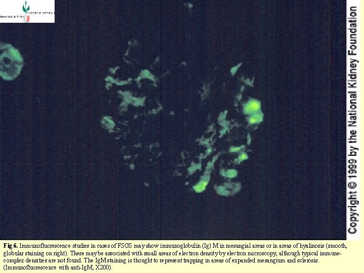  Fig 6. Immunofluorescence studies in cases of FSGS may show immunoglobulin (Ig) M