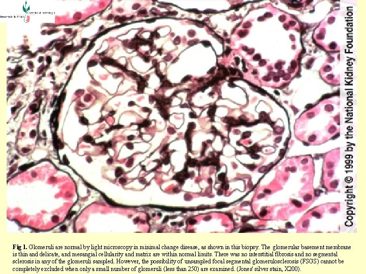  Fig 1. Glomeruli are normal by light microscopy in minimal change disease, as