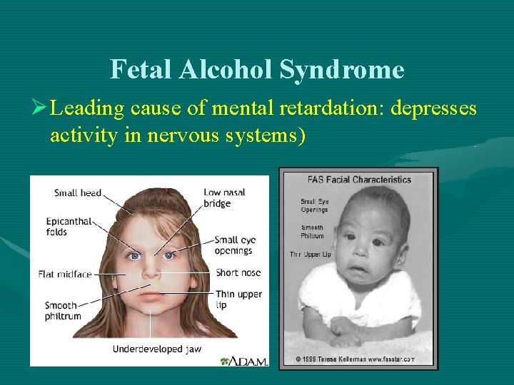 Fetal Alcohol Syndrome Ø Leading cause of mental retardation: depresses activity in nervous systems)
