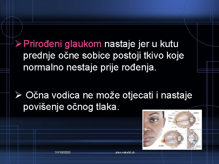Ø Prirođeni glaukom nastaje jer u kutu prednje očne sobice postoji tkivo koje normalno