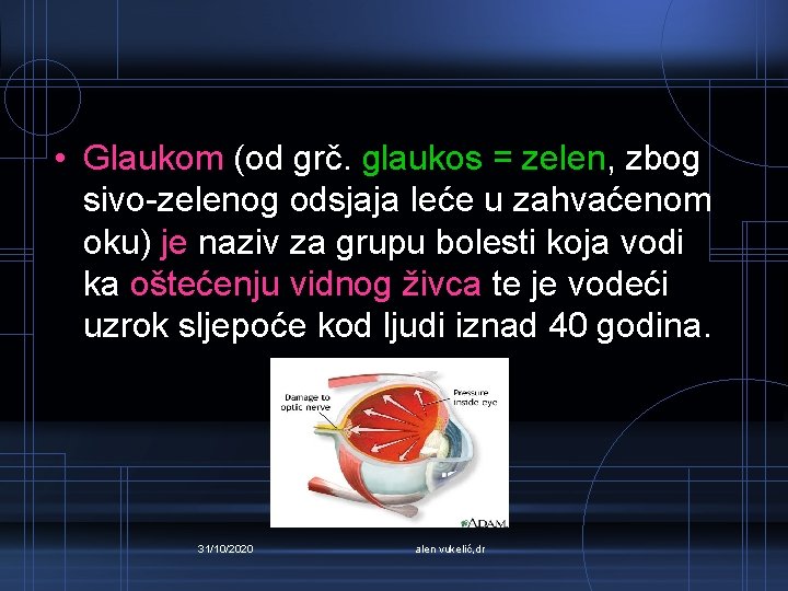  • Glaukom (od grč. glaukos = zelen, zbog sivo-zelenog odsjaja leće u zahvaćenom