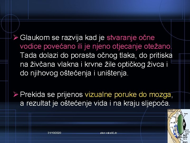 Ø Glaukom se razvija kad je stvaranje očne vodice povećano ili je njeno otjecanje