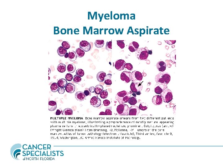 Myeloma Bone Marrow Aspirate 