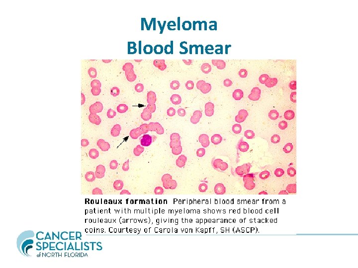 Myeloma Blood Smear 