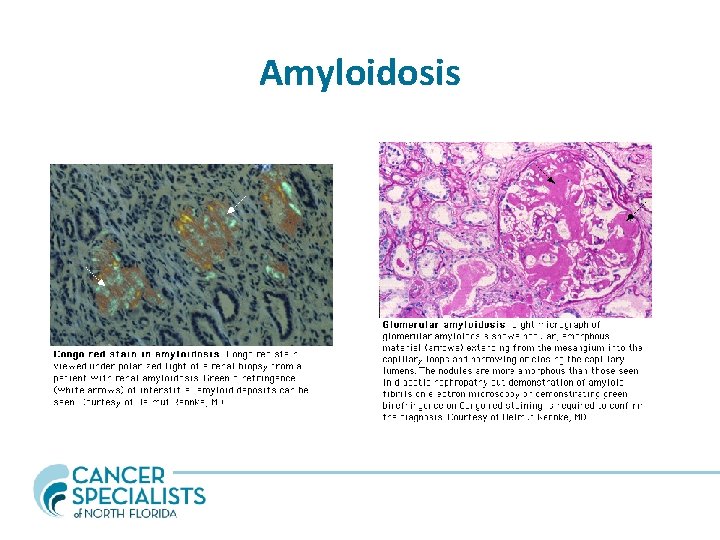 Amyloidosis 