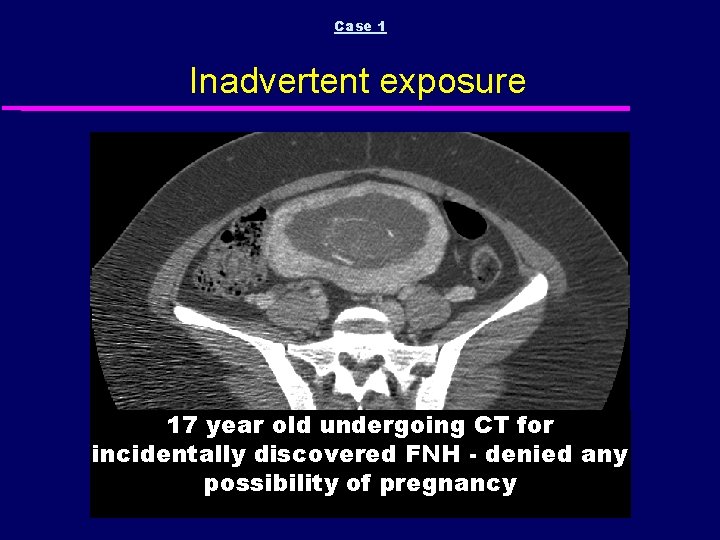 Case 1 Inadvertent exposure 17 year old undergoing CT for incidentally discovered FNH -