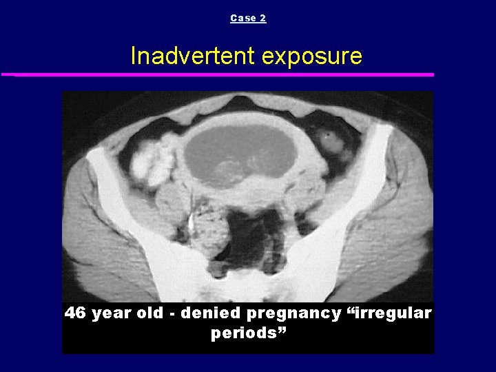 Case 2 Inadvertent exposure 46 year old - denied pregnancy “irregular periods” 