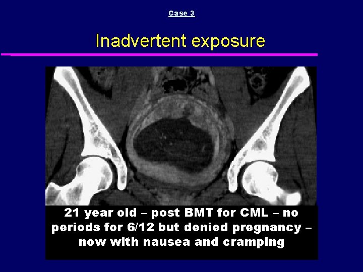 Case 3 Inadvertent exposure 21 year old – post BMT for CML – no