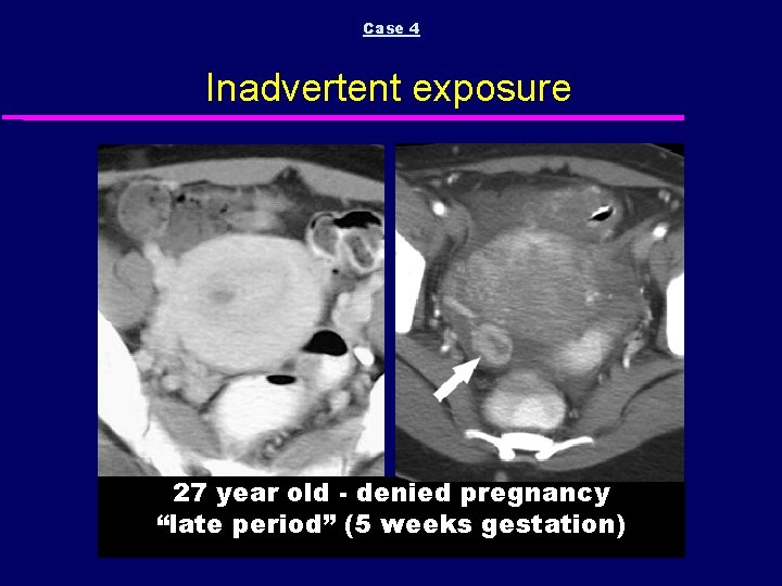 Case 4 Inadvertent exposure 27 year old - denied pregnancy “late period” (5 weeks