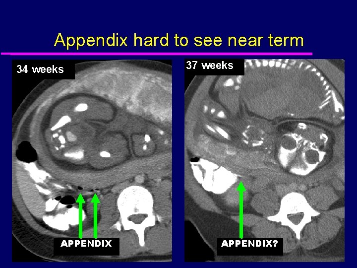 Appendix hard to see near term 34 weeks APPENDIX 37 weeks APPENDIX? 