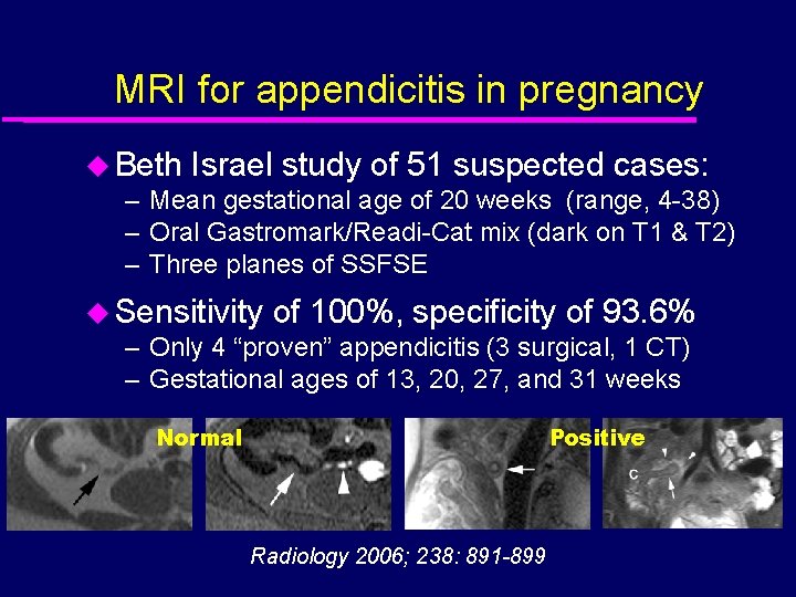 MRI for appendicitis in pregnancy u Beth Israel study of 51 suspected cases: –