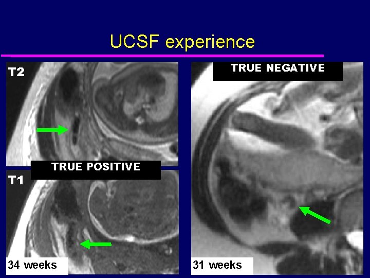 UCSF experience TRUE NEGATIVE T 2 T 1 TRUE POSITIVE 34 weeks 31 weeks