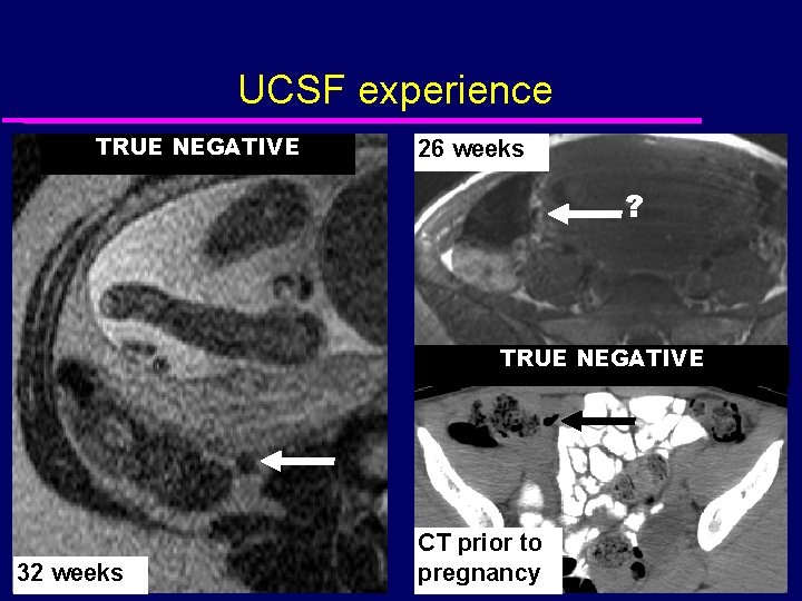 UCSF experience TRUE NEGATIVE 26 weeks ? TRUE NEGATIVE 32 weeks CT prior to